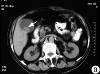 đҽY(ji)ʯCTӰF(xin)