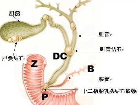 膽結石能自發消失嗎?