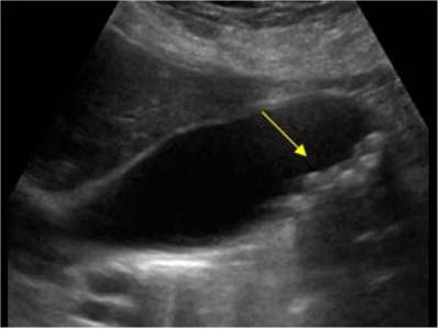 什么是多發(fā)性膽結(jié)石?