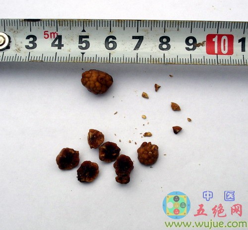 五絕指針療法治療膽總管結石阻塞危癥